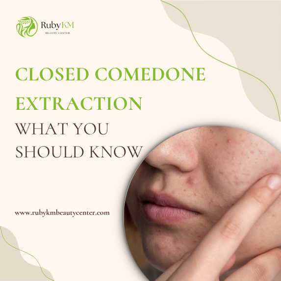 Closed comedones extraction on acne-prone skin