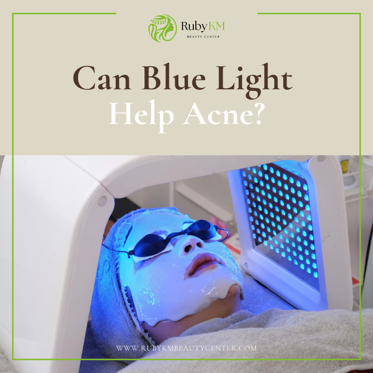 Blue Light Treatment for Acne Who It Helps & When to Consider It