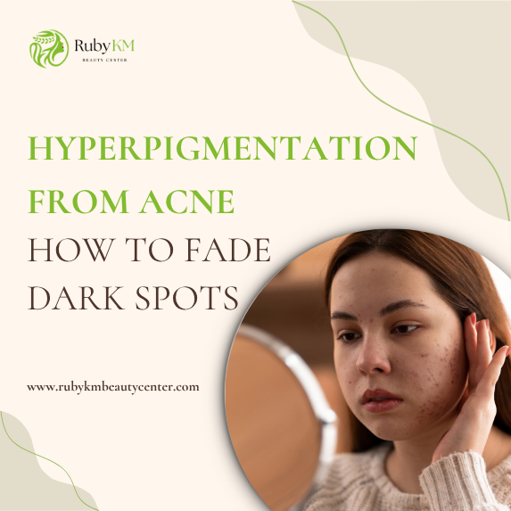 Woman examining acne-prone skin with hyperpigmentation in a mirror