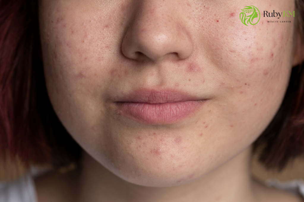 Close-up of acne-prone skin with hyperpigmentation and dark spots