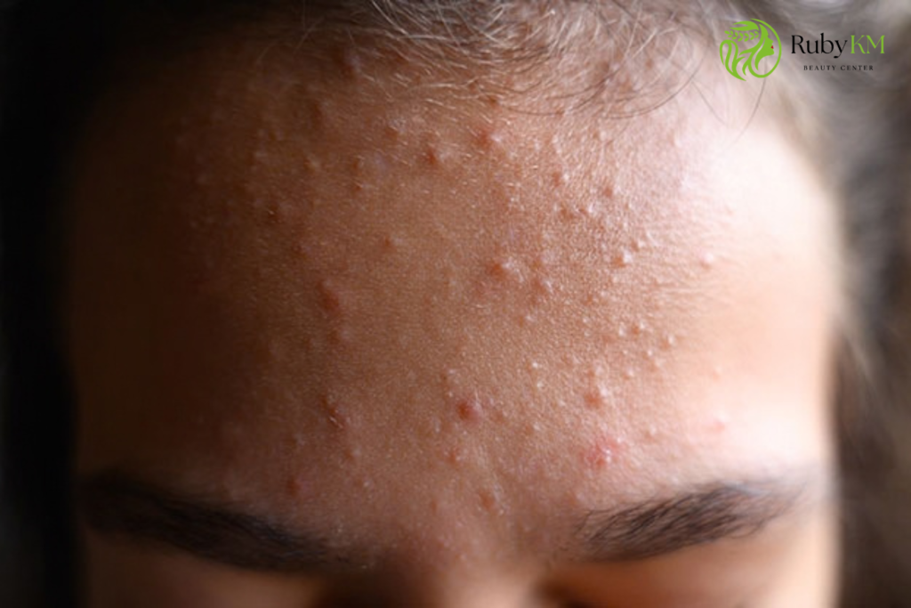 Close-up of forehead with small clogged pores and bumps