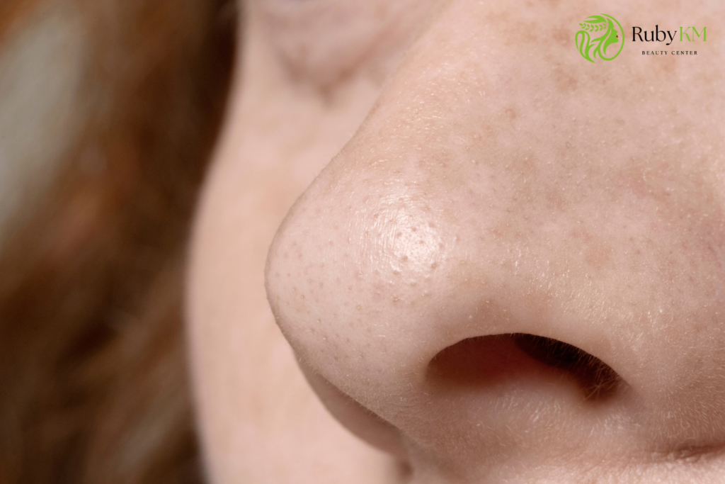 Close-up of clogged pores and blackheads on facial skin