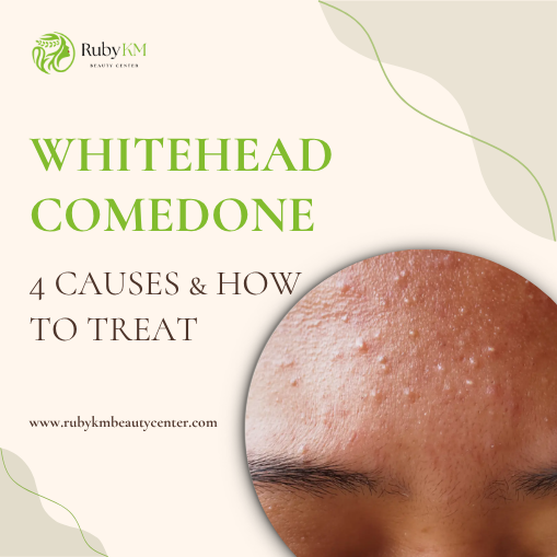 Whitehead comedone: common causes and treatment options for forehead bumps
